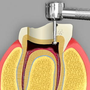 Root Canal Treatment